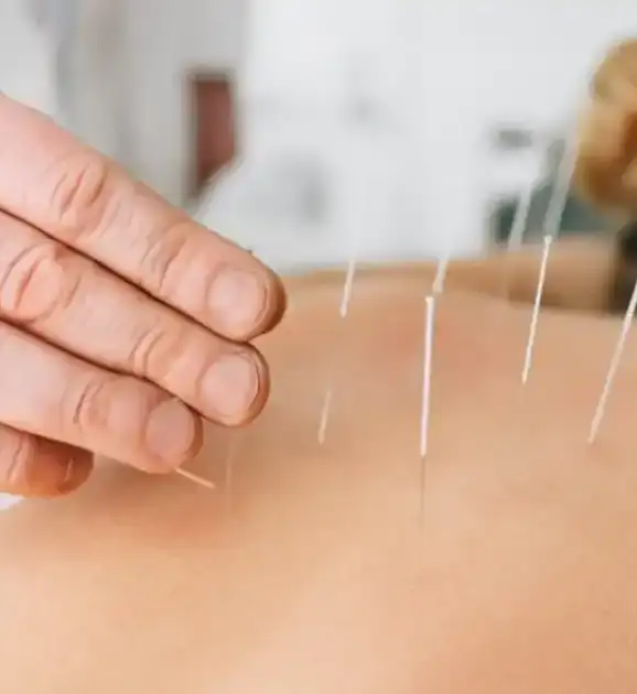 Dry-Needling-1024x722-1