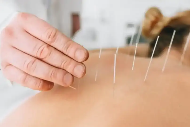 Dry-Needling-1024x722-1